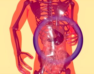 How Iron Overload Can Lead to Liver Toxicity and Organ Damage in Hemochromatosis