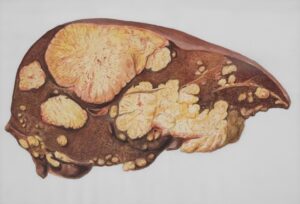 The Connection Between Chronic Liver Inflammation and Insulin Resistance in Adults