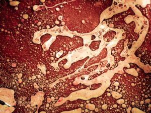 What You Should Know About Liver Cirrhosis and Its Progressive Complications